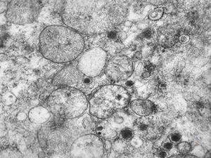 F,36y. | chemodectoma - neck F,36y. | chemodectoma - neck